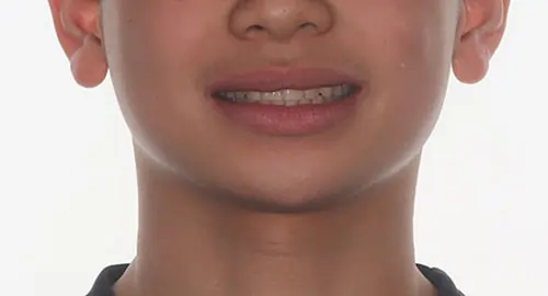 Overbite Patient 10 After 1