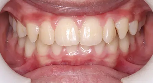 Overbite Patient 10 Before 2