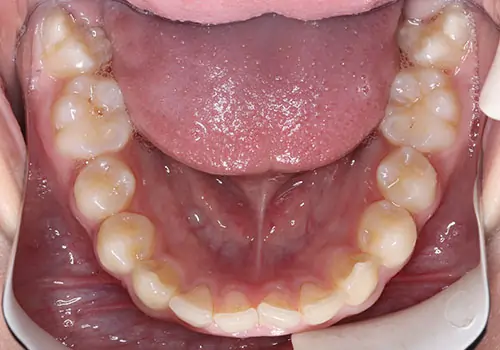 Overbite Patient 10 Before 3