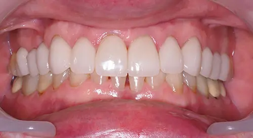 Crowding Patient 14 After 2