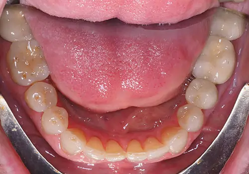 Crowding Patient 14 After 3