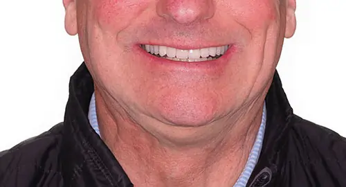 Crowding Patient 14 After 1