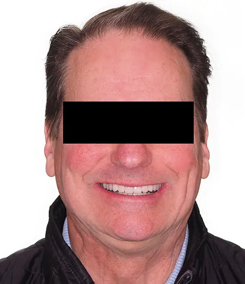 Crowding Patient 14 After 1