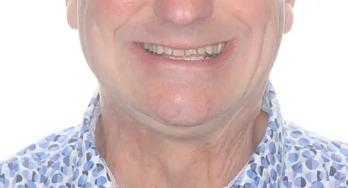 Crowding Patient 14 Before 1