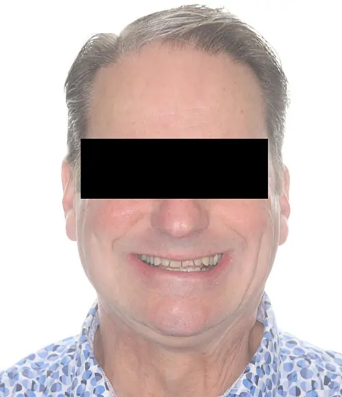 Crowding Patient 14 Before 1