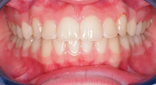 Crowding Patient 15 After 2