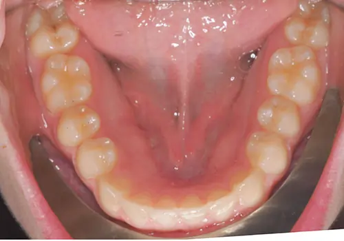 Crowding Patient 15 After 3