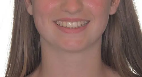 Crowding Patient 15 After 1