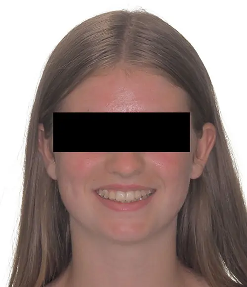 Crowding Patient 15 After 1