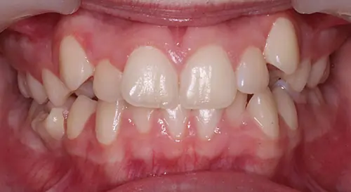 Crowding Patient 15 Before 2