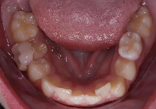 Crowding Patient 15 Before 3