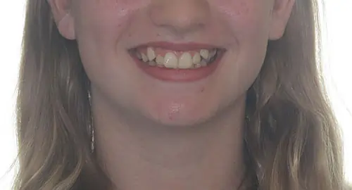 Crowding Patient 15 Before 1