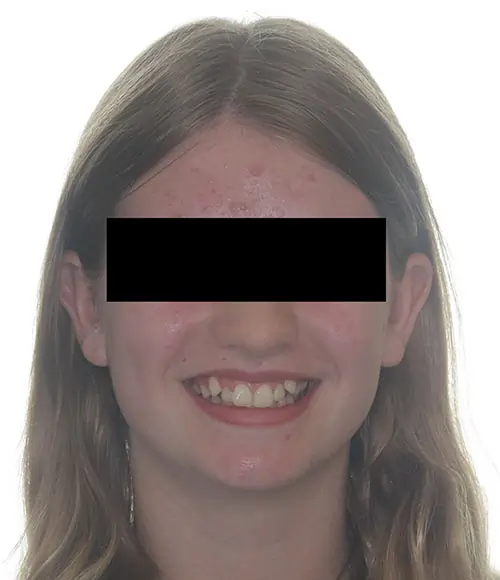 Crowding Patient 15 Before 1