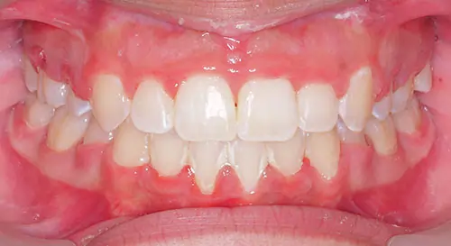 Crowding Patient 16 After 2