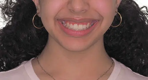 Crowding Patient 16 After 1