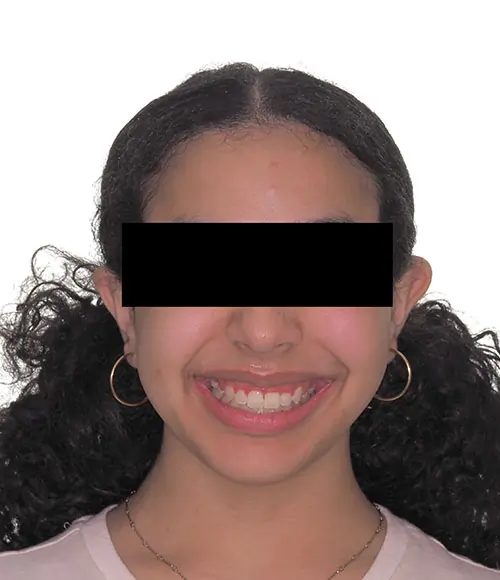 Crowding Patient 16 After 1