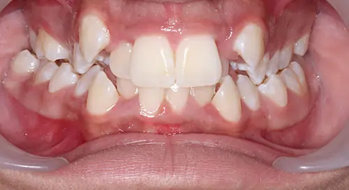 Crowding Patient 16 Before 2