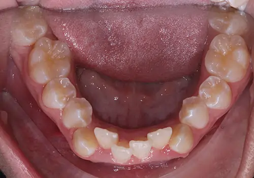 Crowding Patient 16 Before 3