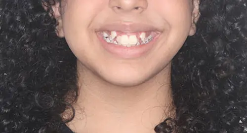 Crowding Patient 16 Before 1