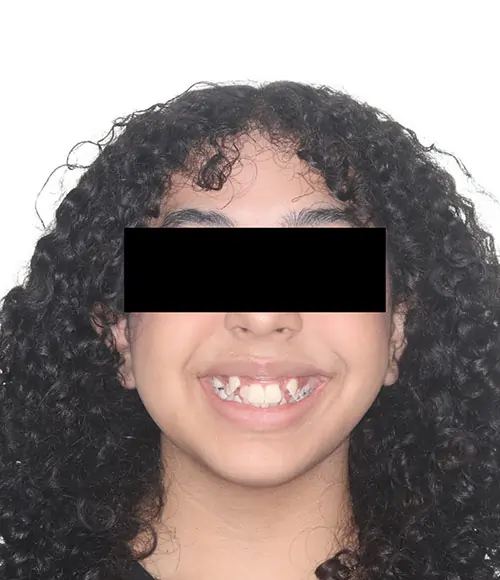 Crowding Patient 16 Before 1