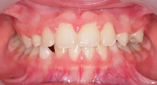 Phase 1 Patient 12 After 2