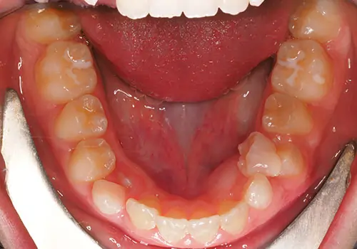 Phase 1 Patient 12 After 3