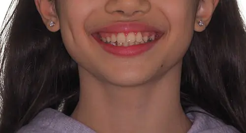 Phase 1 Patient 12 After 1