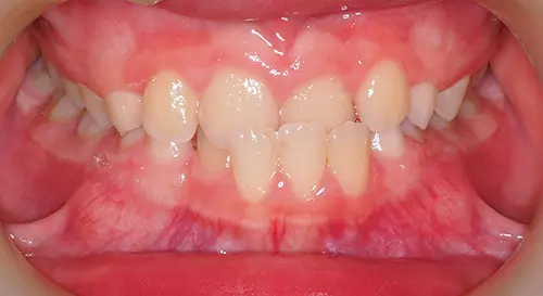 Phase 1 Patient 12 Before 2