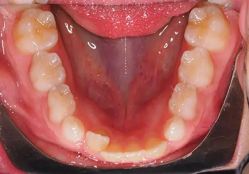 Phase 1 Patient 12 Before 3