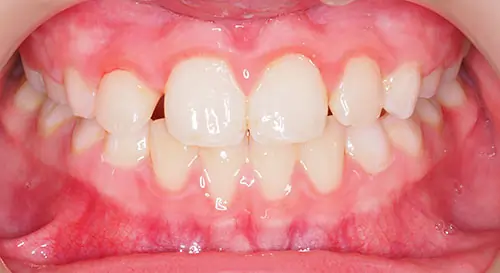 Phase 1 Patient 13 After 2