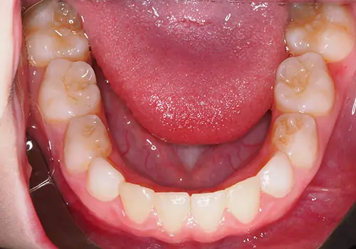 Phase 1 Patient 13 After 3