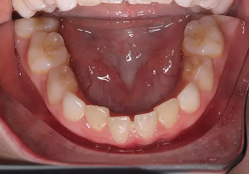 Phase 1 Patient 13 Before 3