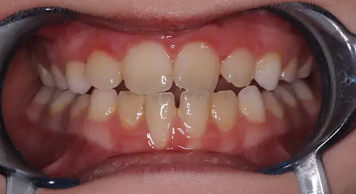 Phase 1 Patient 13 Before 2