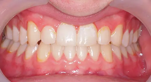 Crowding Patient 17 After 2