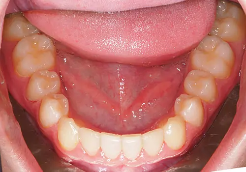 Crowding Patient 17 After 3
