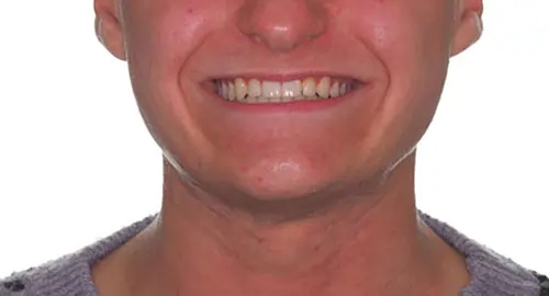 Crowding Patient 17 After 1