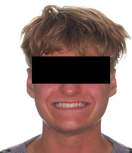 Crowding Patient 17 After 1