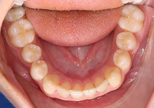 Crowding Patient 17 Before 3