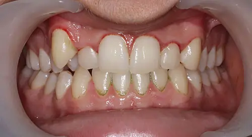 Crowding Patient 17 Before 2