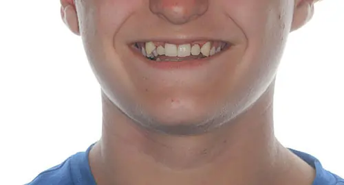 Crowding Patient 17 Before 1