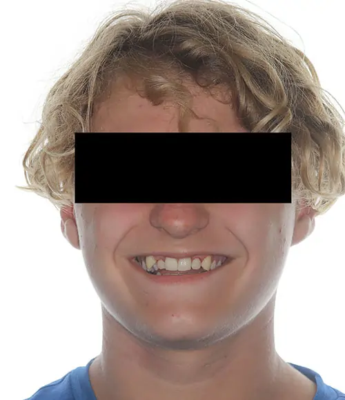 Crowding Patient 17 Before 1