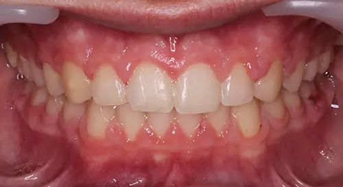 Overbite Patient 9 After 2