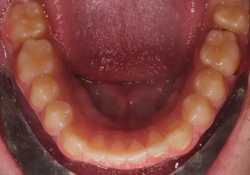 Overbite Patient 9 After 3