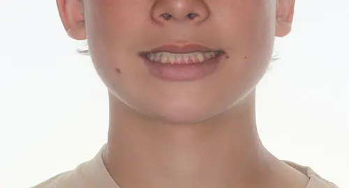 Overbite Patient 9 After 1