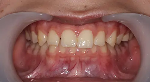 Overbite Patient 9 Before 2