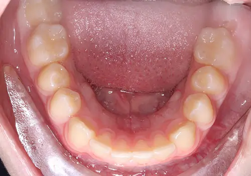 Overbite Patient 9 Before 3