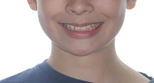 Overbite Patient 9 Before 1