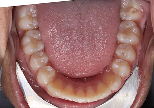Crowding Patient 18 After 3