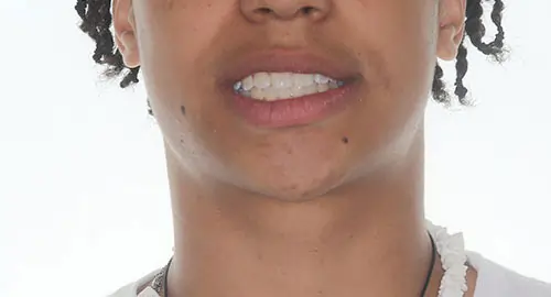 Crowding Patient 18 After 1