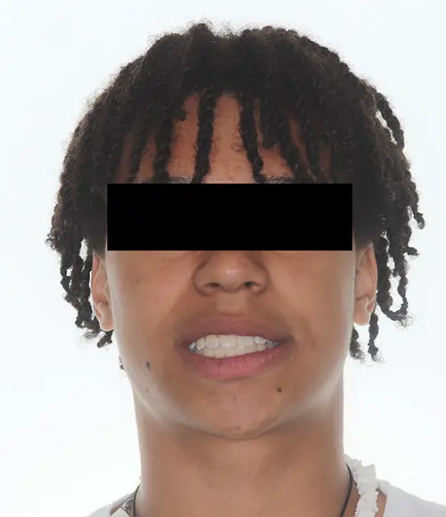 Crowding Patient 18 After 1